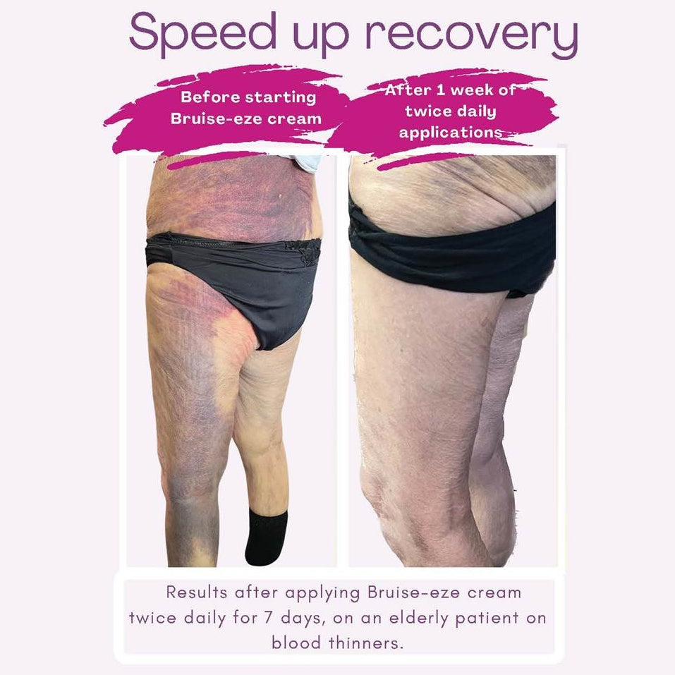 Bruise-eze Airless 30ml